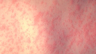 Alabama health experts encourage Measles vaccine for kids following series of outbreaks [Video]