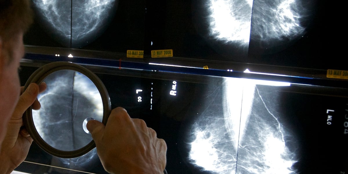 Mammograms should start at 40 to address rising breast cancer rates at younger ages, panel says [Video]