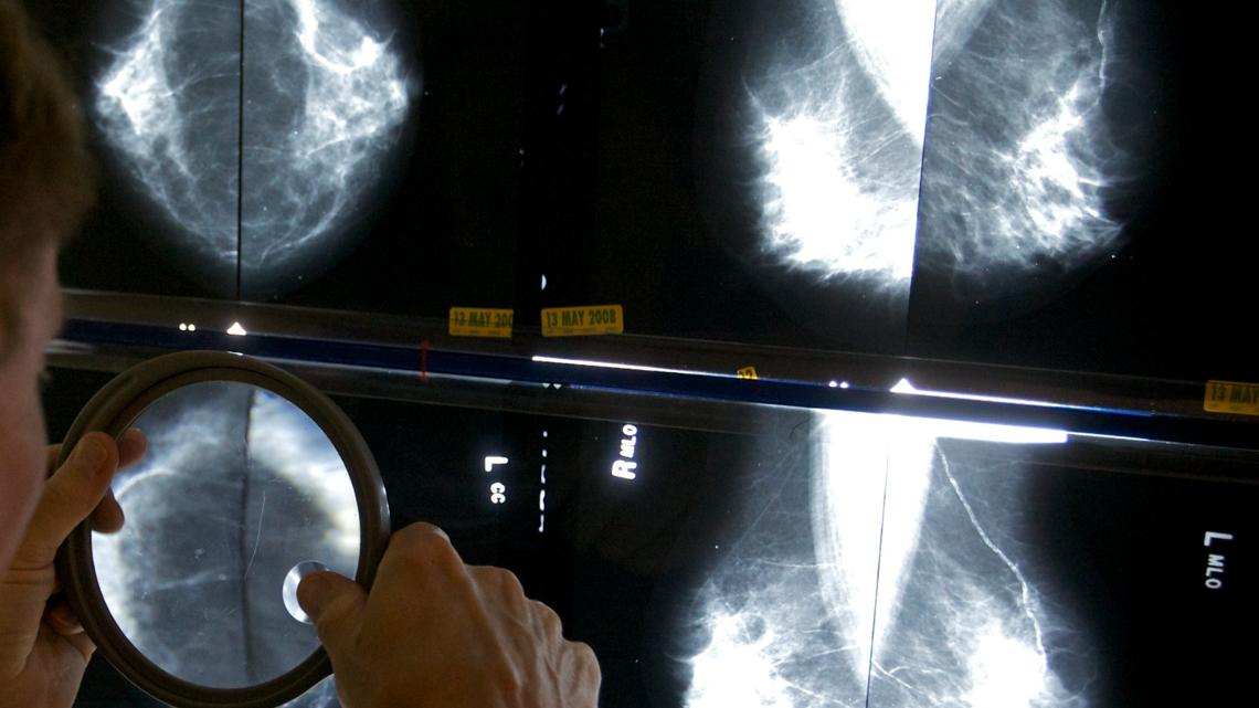 Mammograms should start at 40, panel says [Video]