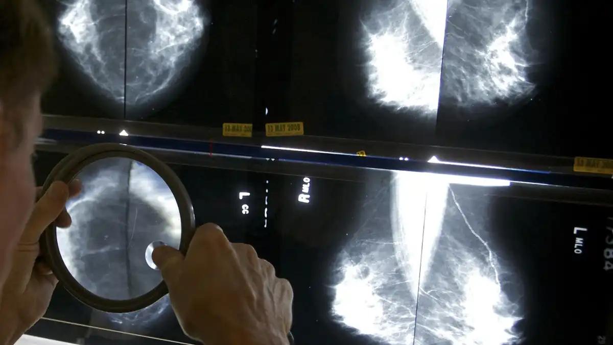 Mammograms recommended starting at 40 amid rising younger breast cancer rates [Video]