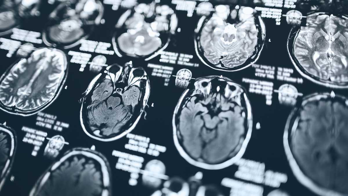 What to know about football brain trauma and CTE [Video]